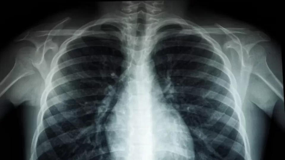 Alerta sanitaria en México: Salud advierte por un repunte significativo de tosferina en 2025