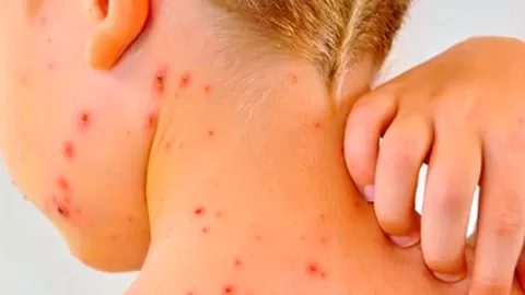 Alerta Sanitaria en México: Varicela Se Dispara con 50 Mil Contagios en 2025; Conoce los Estados Más Afectados y la Urgencia de Vacunación