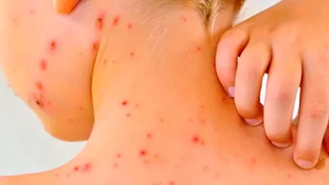 Alerta Nacional por Sarampión: México Supera 5,800 Casos y Refuerza Vacunación Ante Brotes Activos en Varios Estados