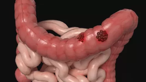 Alerta Sanitaria: Cáncer Colorrectal, Primera Causa de Muerte por Cáncer en Menores de 50 Años, Superando al de Pulmón