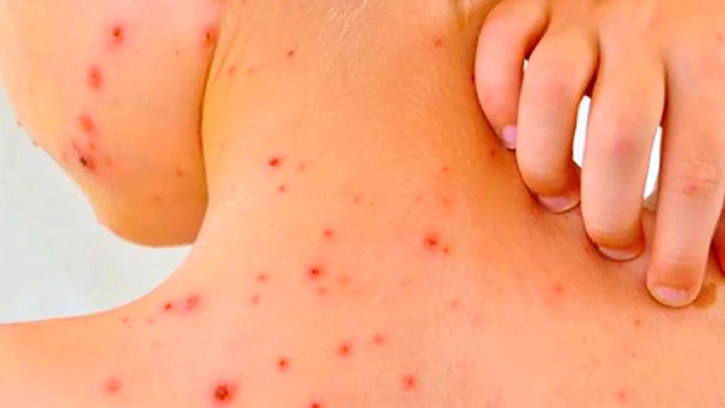 Sarampión en México: Brote Rebasa 10 Mil Casos y Causa 31 Muertes