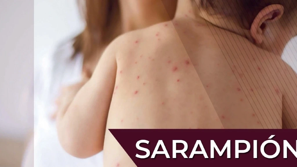 Alerta en Sinaloa: El Estado entre los Más Afectados por Brote de Sarampión y Refuerza Campaña de Vacunación Nacional
